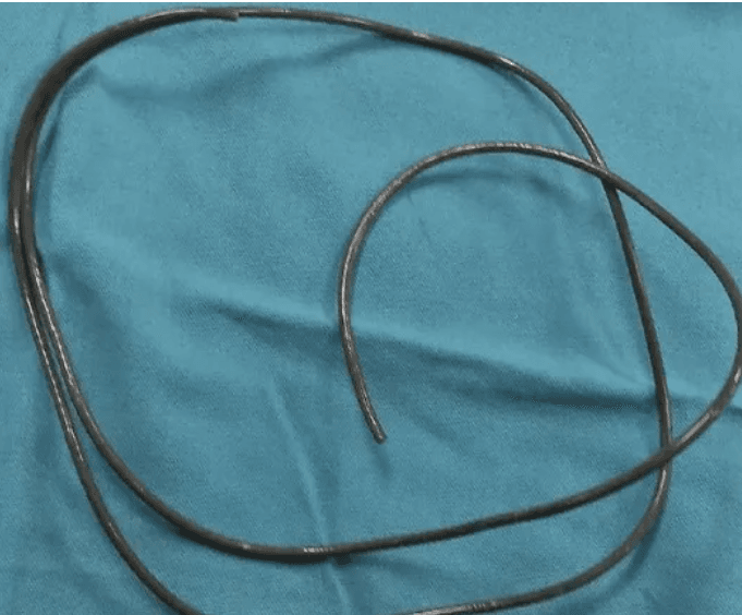 80cm Earphone Stucked In Man's Bladder