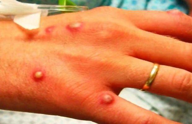 Monkeypox Outbreak