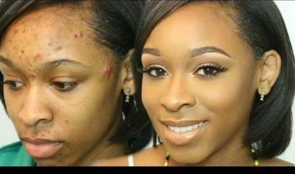 Beauty Hack: Say Goodbye to Pimples Forever by Following these 6 Simple Steps