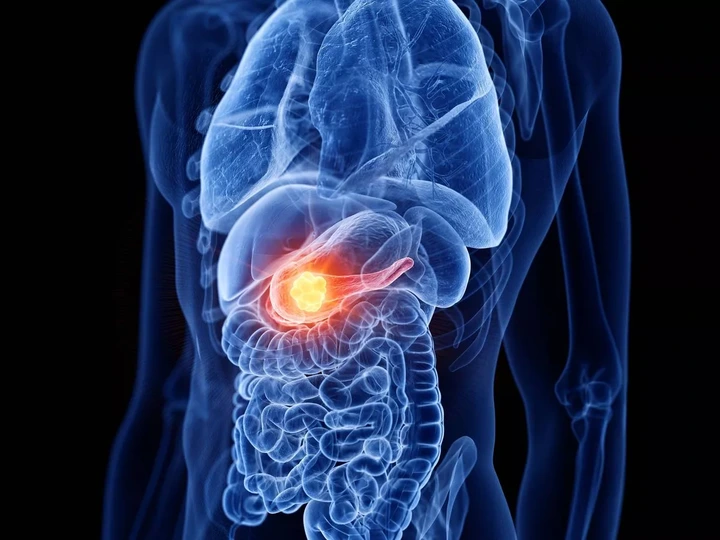 Four Critical Warning Signs Of Pancreatic Cancer That May Appear In Your Legs Four Critical Warning Signs Of Pancreatic Cancer That May Appear In Your Legs