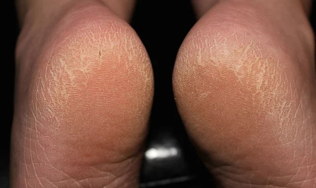 8 Easy Remedies To Soothe Cracked Heels And Keep Your Skin Soft